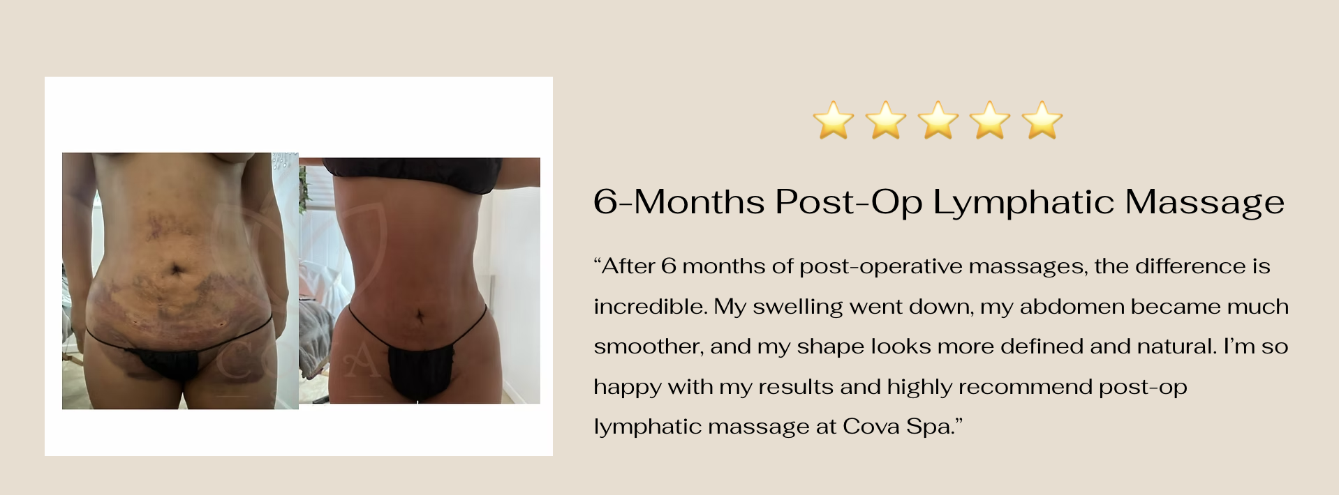 6-Month Post-Op Lymphatic Massage results — before and after at Cova Spa