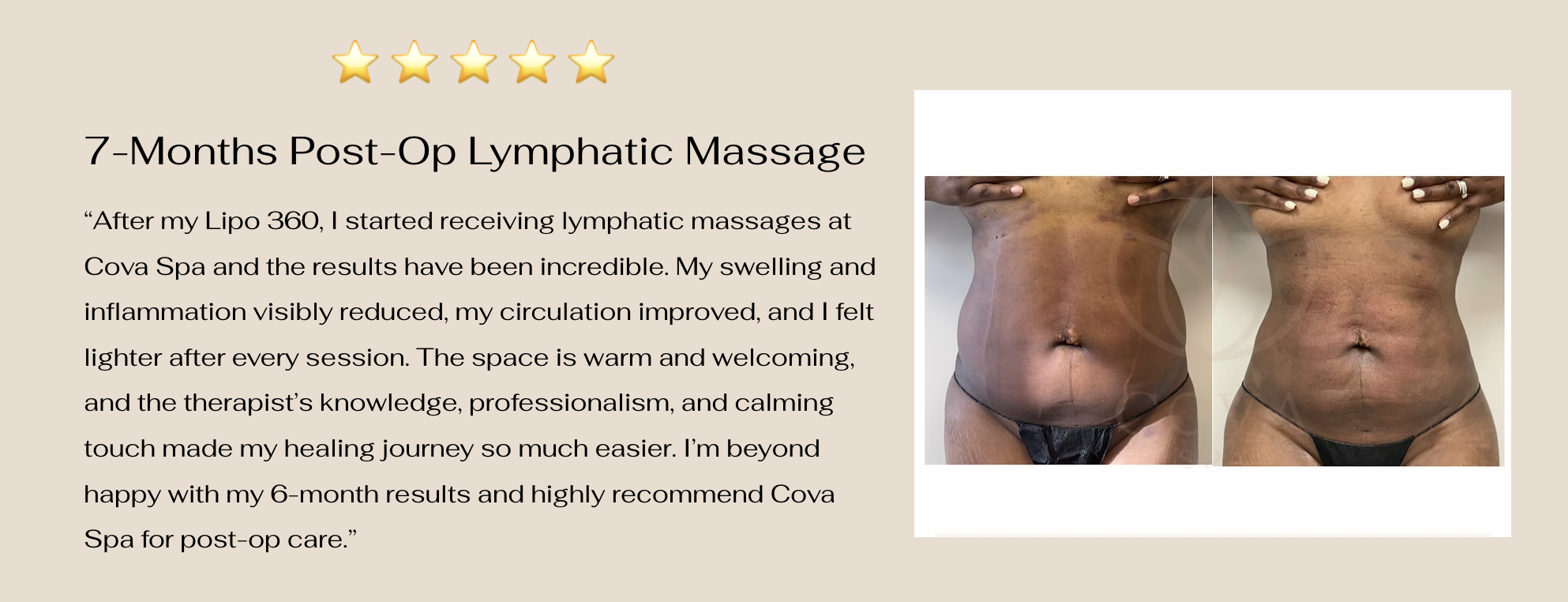 7-Month Post-Op Lymphatic Massage results — before and after at Cova Spa