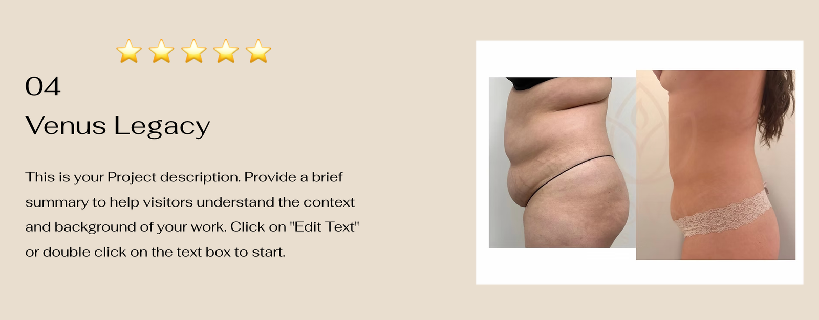 Venus Legacy body contouring results at Cova Spa
