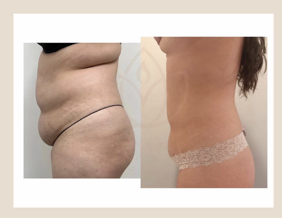 Venus Legacy body contouring results — before and after at Cova Spa